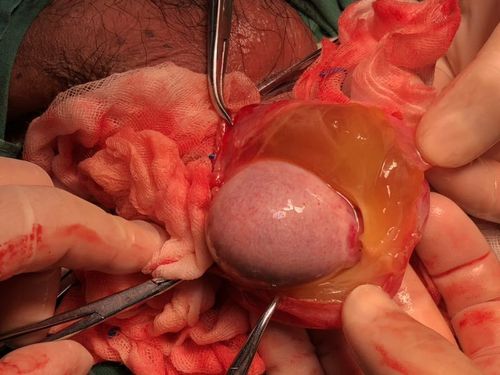 蛋蛋历险记(一)附睾坏死