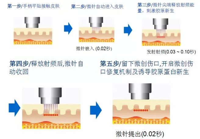 石家庄巍名仕除皱新仪器黄金微针,专治不漂亮!