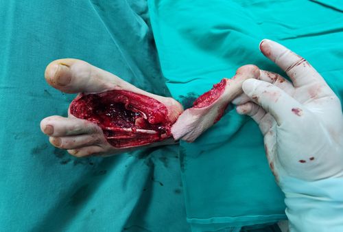 白银市第一人民医院手足显微外科完成一例复合组织瓣游离移植拇指再造