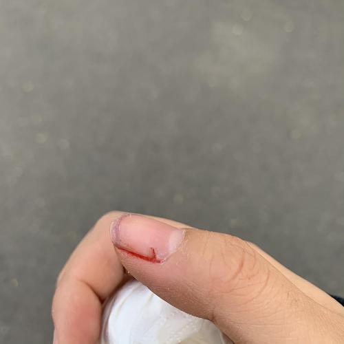 (慎入)上个月把指甲拔了以后 不知道怎么养