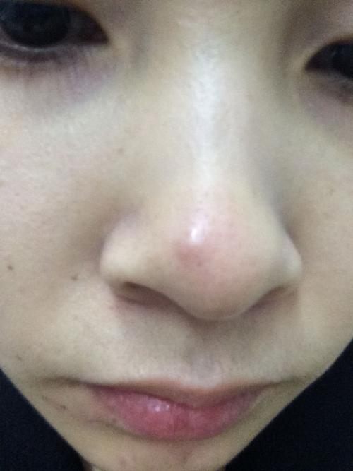 鼻子上长了一个这样的痘痘,一个多礼拜了,最开始不痛