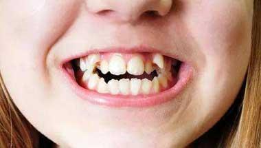 宝宝满嘴龅牙是安抚奶嘴惹的祸? 宝宝到底需不需要用安抚奶嘴?