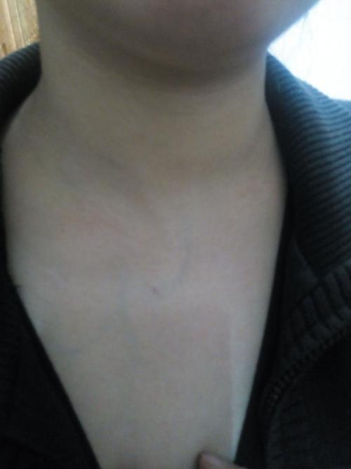 5楼 我脖子血管出来明显