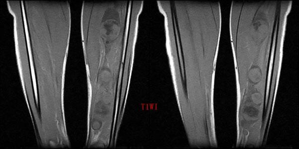 mri0011:小腿占位
