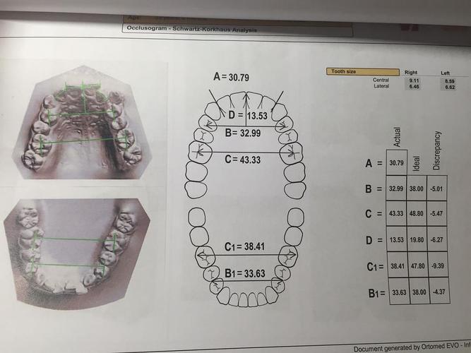 海外党矫正,扩牙弓方案和拔牙方案,求分析.