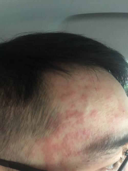 我额头右上角经常起一块一块的红斑,发痒且成片,反复发作,不知