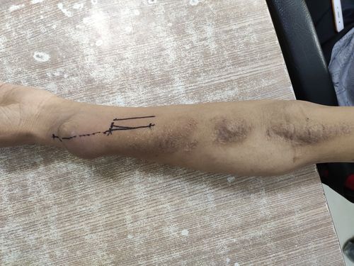 左前臂桡动脉-头静脉动静脉内瘘使用多年,近期出现内瘘吻合口处动脉瘤