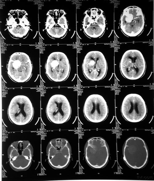昨天刚收的病人,以头痛就诊,无视神经损害症状,查头颅ct发现鞍区肿瘤