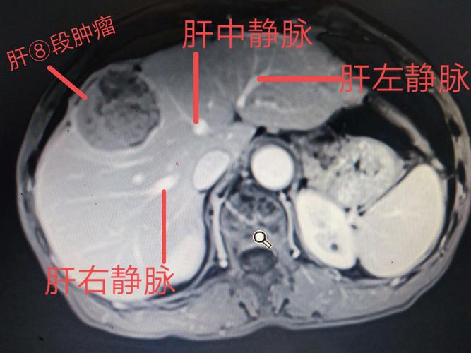 一例中肝癌病例分享