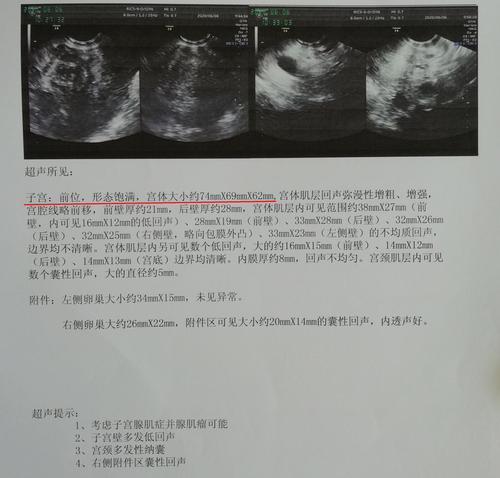 得了子宫腺肌症的她,4次试管婴儿都失败了!王斌保宫手术12天后重生