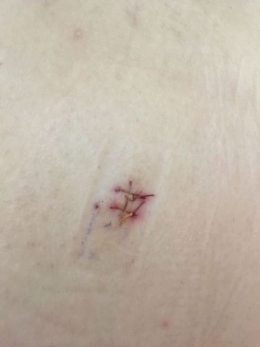 手术后缝针 现在针眼有点发红 想帮忙给看看是不是发炎感染了