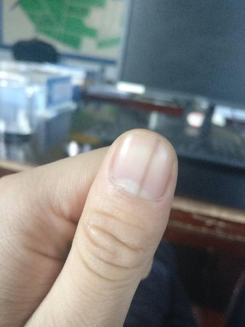 请问下大母手指指甲上有条黑线是怎么回事,好多年了.