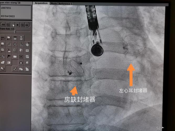 贵州首例黔南州人民医院成功完成房间隔缺损左心耳封堵一站式手术