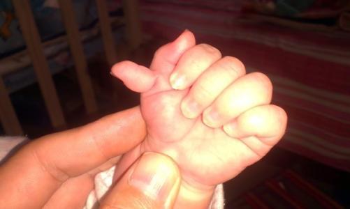 新生儿六指的原因是什么?
