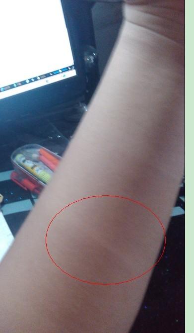 很细,就像是有条线一样,我胖,位置在小臂上,下面是图片,两边都有,这