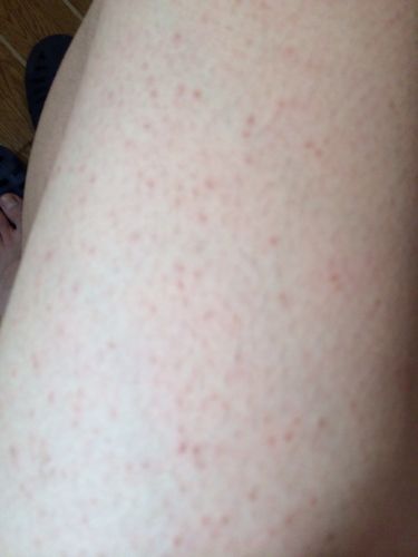 皮肤性病科 皮肤科 → 腿上的小红疙瘩怎么回事.