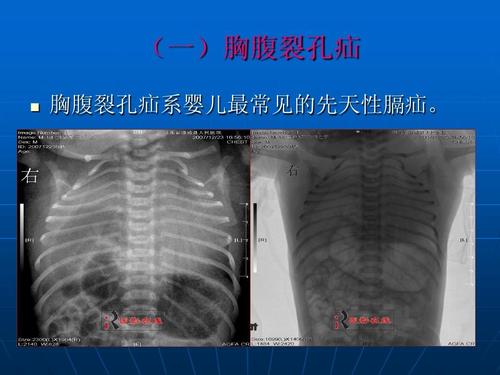 (一)胸腹裂孔疝   胸腹裂孔疝系婴儿最常见的先天性膈疝.