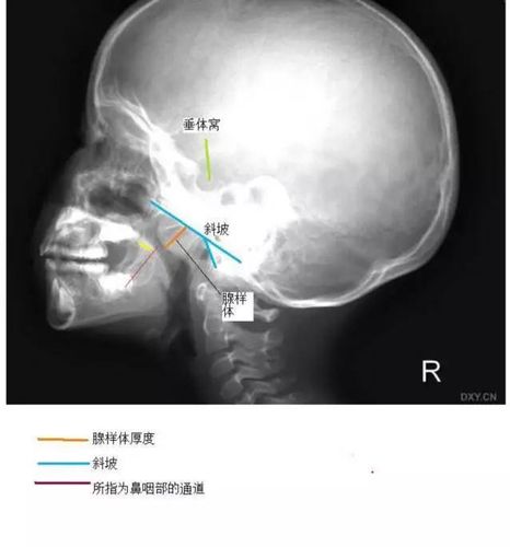 影像与临床 ▏鼻咽部侧位片诊断儿童腺样体肥大