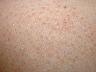 其特点为毛囊性或非毛囊性皮肤过度角化而形成的圆锥形角化性丘疹