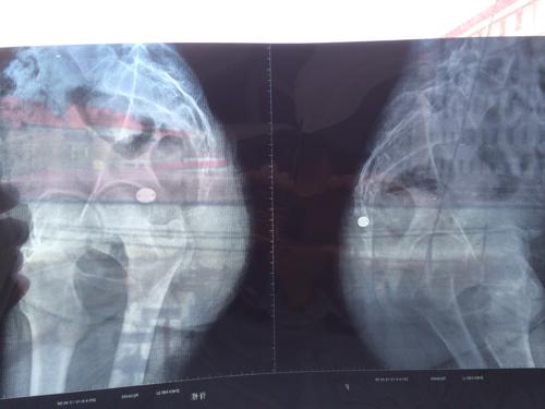 我女朋友前两天尾椎骨摔疼了,照了片,麻烦