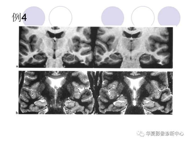 海马解剖结构与海马硬化的mri诊断