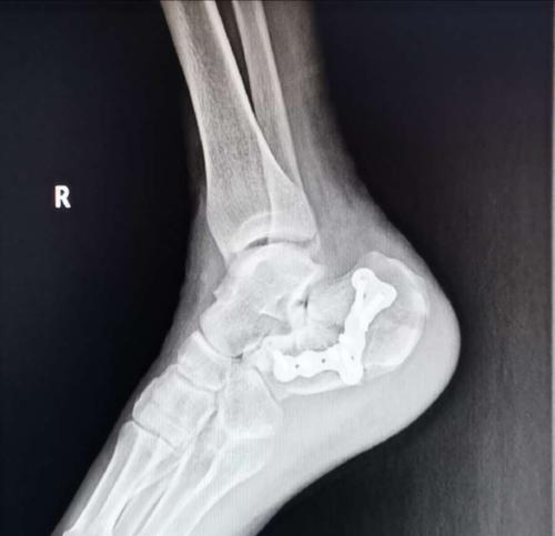 爱爱医病例中心 外科 骨科 双足跟骨粉碎性骨折治疗