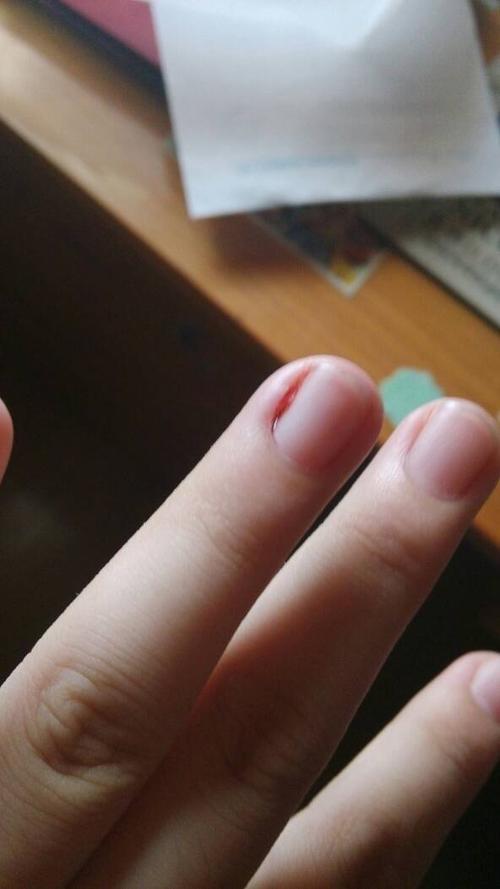 如图我的手上指甲左右都经常出血 倒也没什么事 就是最近愈来愈疼