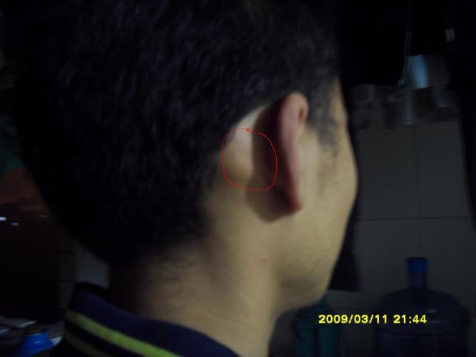 耳朵后面的骨头异常长大(右边是左边的一倍)而且时常有疼的感觉感冒时