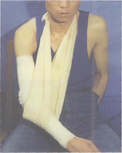 (图3-2-28) 二,固定 患肘屈曲45°位,背侧长臂石膏托固定,三角巾悬吊