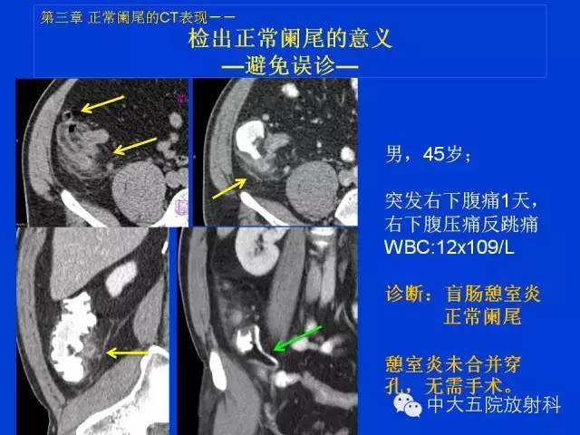 【经典之作】正常阑尾和阑尾炎的ct表现