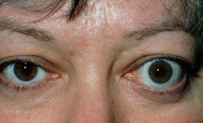 甲亢突眼