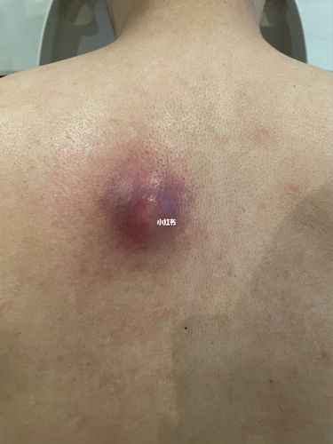 一个皮脂腺囊肿的惨痛经历_发炎_痛经_引流_nurofen