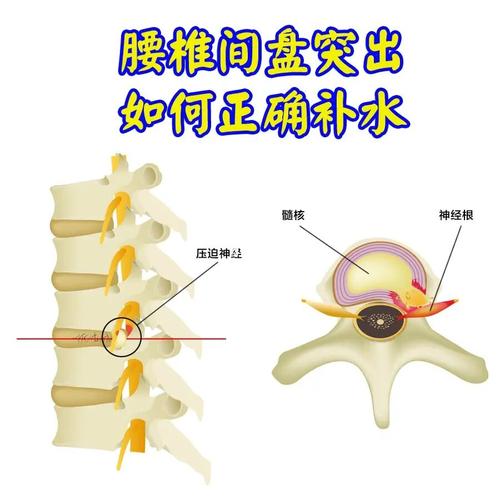 凭什么可悦龄可以治愈腰椎间盘突出?_透明质酸_腰间盘