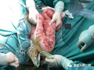结肠广泛显著扩张,结合病史符合先天性巨结肠影像表现