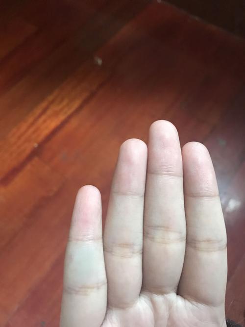 小手指肚一大块青绿色 好几年了 从来没有受过伤就这个颜色了 是怎么