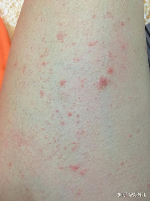 再也别见了,玫瑰糠疹!