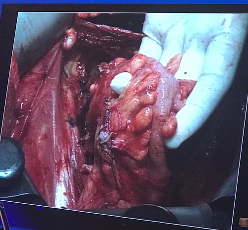 晚期卵巢癌脏层腹膜肿瘤灭术(大量手术图片)