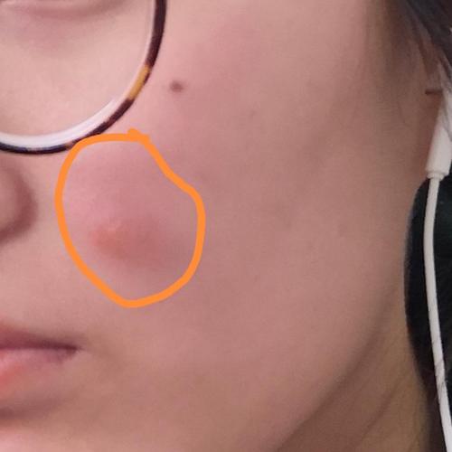 (有后续,看医生了)求助,脸上长了好像火疖子的东西