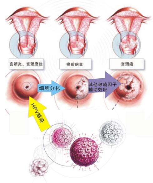 其它 宫颈癌疫苗接种就在家门口 写美篇 等,导致生殖器疣(尖锐湿疣).