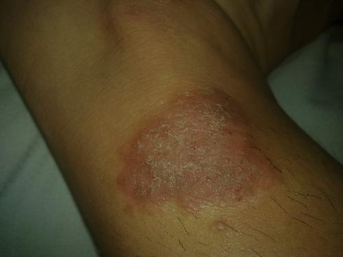 脚踝上张得,四五年了,貌似是神经性皮炎,好几年了,去医院看了好多回都