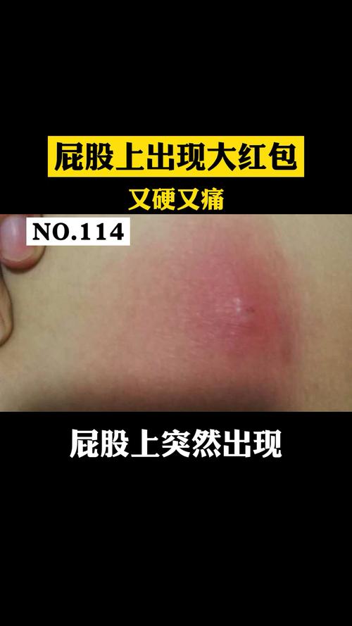 感染有关系,这是要解锁,我们一般分为两个阶段暂接种没有化脓的时候呢