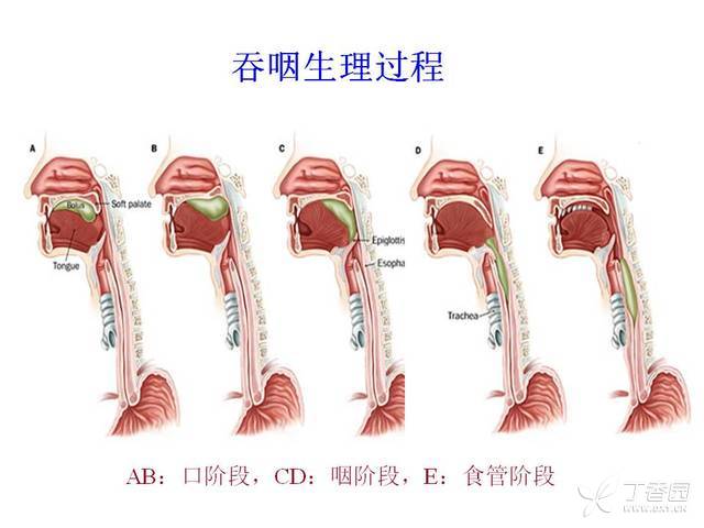 脑卒中后吞咽困难的管理