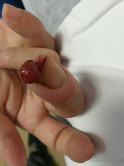 手指血管瘤的处理