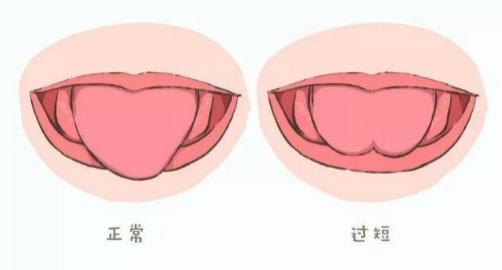 宝宝舌系带短剪还是不剪