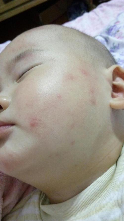宝宝脸长红痘痘不知道怎么了