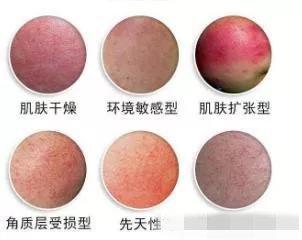 洗脸后皮肤感到紧绷,干燥,甚至脱屑,这是因为皮肤屏障受损,导致肌肤