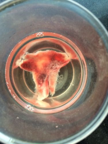 这是胚胎流出来了吗?自然流的,怀孕50天