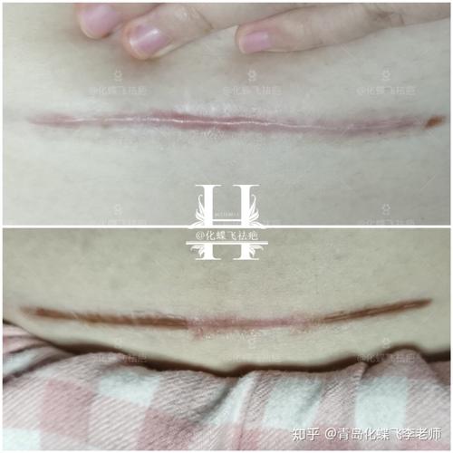 剖腹产疤痕增生变化过程
