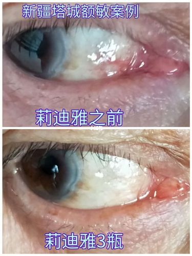 畏光,五年飞蚊症,五十多年迎风流泪_拍照_滴眼液_视力