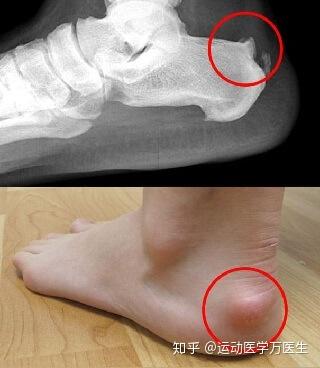 2,跟腱附着在脚后跟部位的疼痛 3,脚后跟肿胀 4,脚后跟皮肤发炎,肿胀
